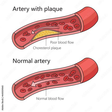 atherosclerotic aorta in tagalog|Arteriosclerotic Aortic Disease .